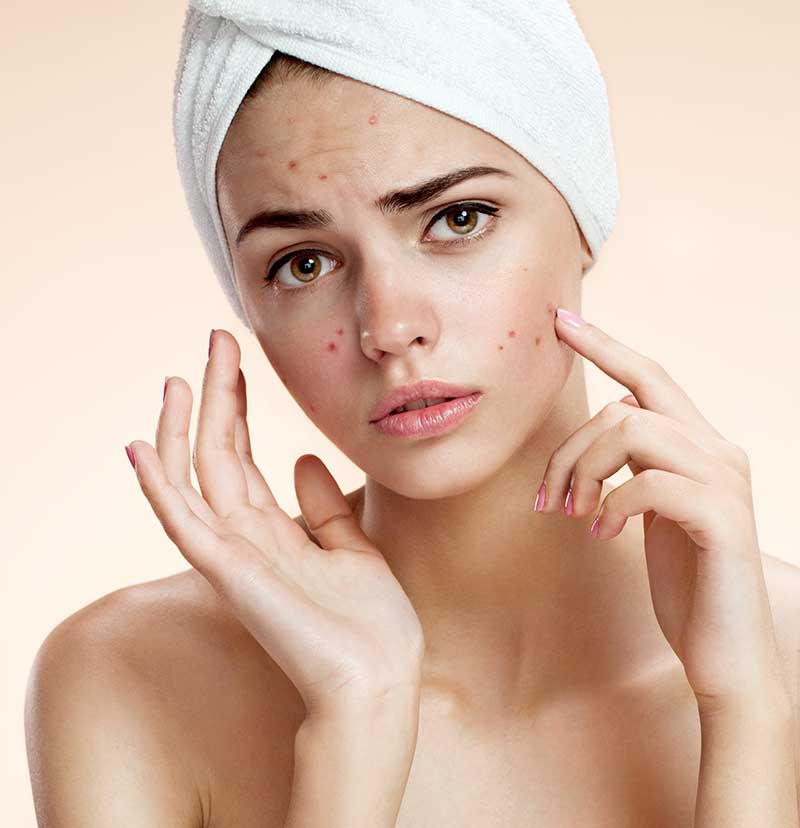 Acne-management-singapore2