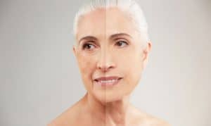 Benefits of Depigmentation Pico Laser